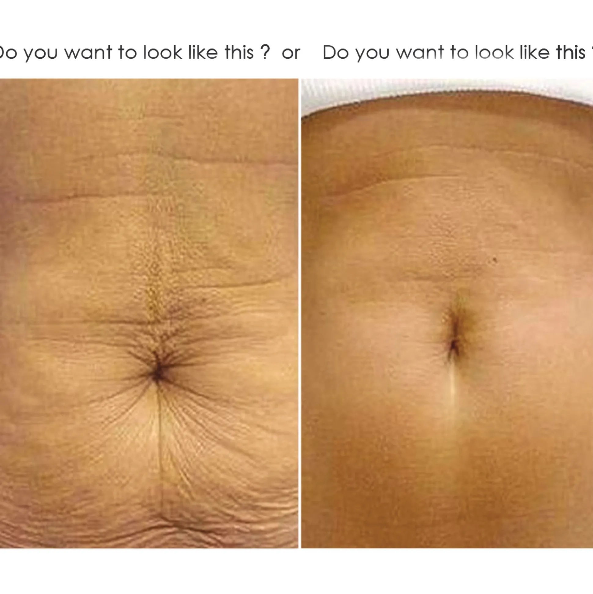 IGIÁ Crepe Gone Skin Firming Stretch Mark Cream